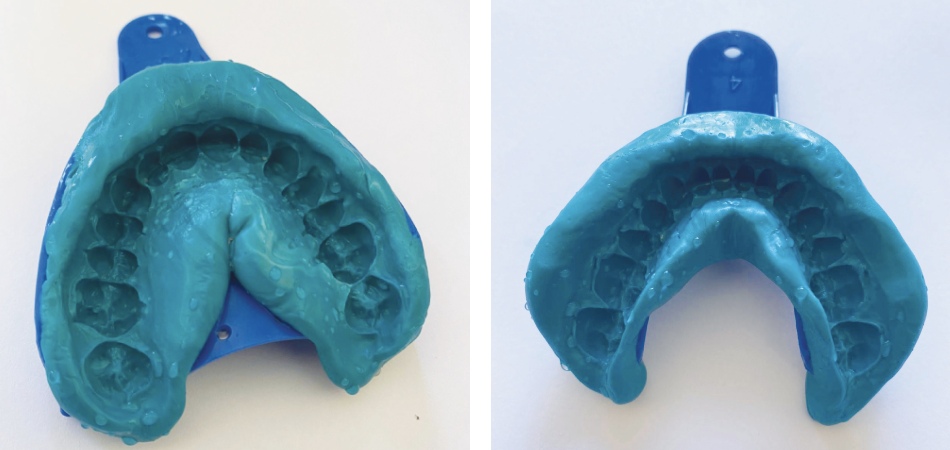 How to Take Impressions - Clip In Veneers from Need That Smile